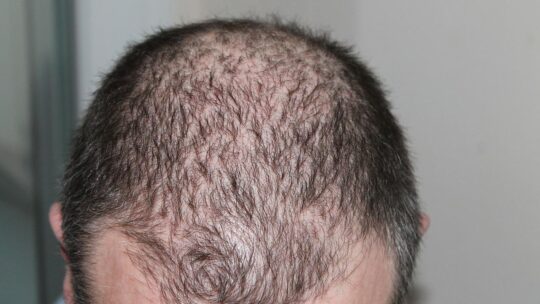 Haartransplantatie in Turkije: waarom is dit een goede keuze?